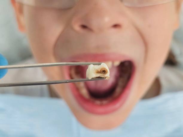 Best Pediatric Emergency Dentist in Lincolnton, GA